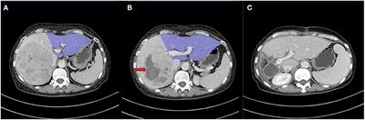 Sequential Portal Vein Embolization and Percutaneous Radiofrequency Ablation for Future Liver Remnant Growth: A Minimally Invasive Alternative to ALPPS Stage-1 in Treatment of Hepatocellular Carcinoma